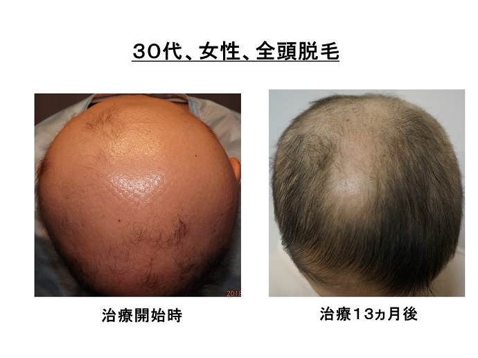 円形脱毛症　病院